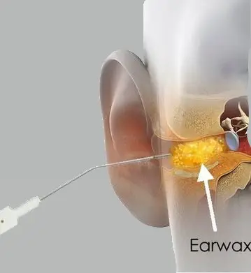 Show Ear Wax Removal